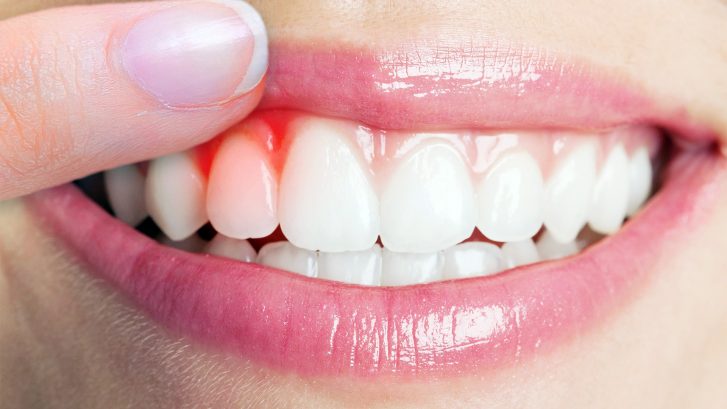 Diş Eti Şişmesi Nedenleri ve Tedavisi