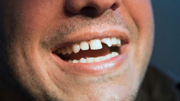 Kırık Diş Tedavisi Nasıl Yapılır?