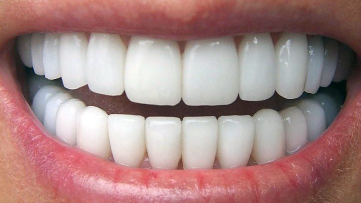 Porselen Diş Kaplama Nedir? Nasıl Yapılır?