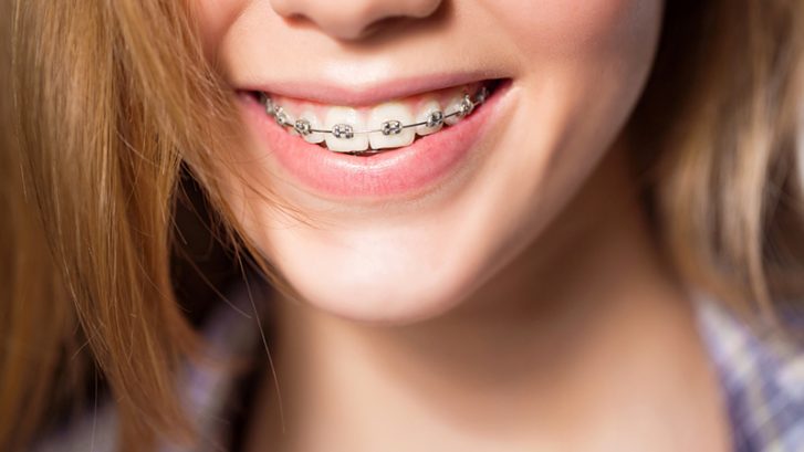 Ortodonti (Diş Teli) Uzmanı – Ortodontist