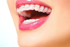 estetik diş teli