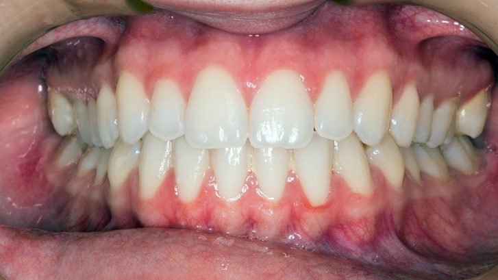 Diş Eti Çekilmesi Nedir? Nasıl Tedavi Edilir?