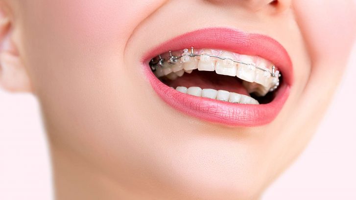 Diş Teli (Ortodonti) Fiyatları – En Güncel Bilgiler